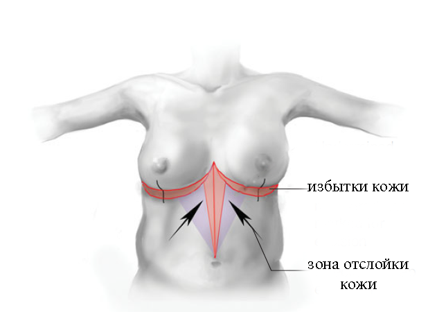 reverse abdominoplasty, обратная абдоминопластика, абдоминопластика с разрезом в подгрудной складке