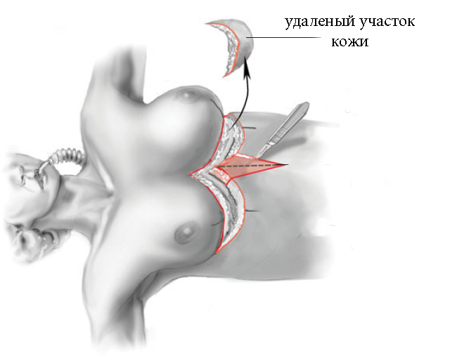 reverse abdominoplasty, обратная абдоминопластика, абдоминопластика с разрезом в подгрудной складке