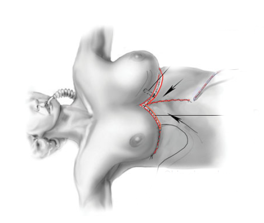 reverse abdominoplasty, обратная абдоминопластика, абдоминопластика с разрезом в подгрудной складке