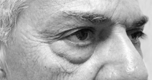 нижняя блефаропластика и липофилинг, нижняя блефаропластика осложнения, нижняя блефаропластика отзывы